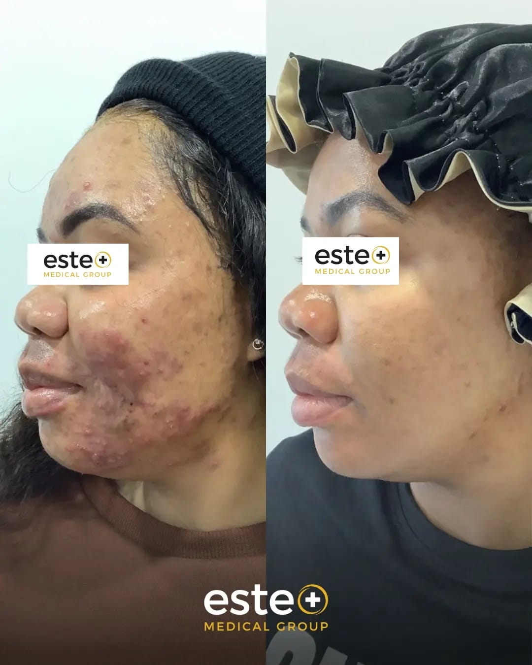 Inflamed Adult Acne Completely Cleared Up! Este